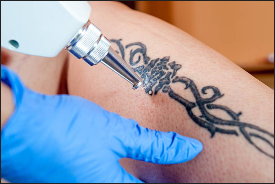 Laser Tattoo Removal: Safe, Effective & Scientifically Proven Method at Cabello-Piel Clinic